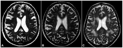 Small Vessel Disease on Neuroimaging in a 75-Year-Old Cohort (PIVUS): Comparison With Cognitive and Executive Tests